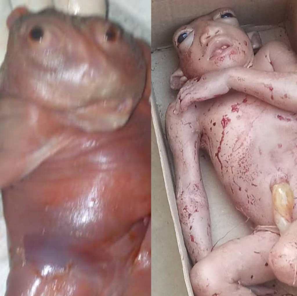 Kasaï-Central : Naissance d&rsquo;un &laquo;&nbsp;enfant monstre&nbsp;&raquo; à Demba, un deuxième cas en quelques&nbsp;jours